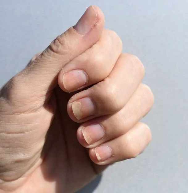Причины ребристой поверхности ногтей на руках